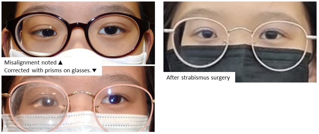 Eyesight Issue2 2022 Psychological Effects Of Strabismus